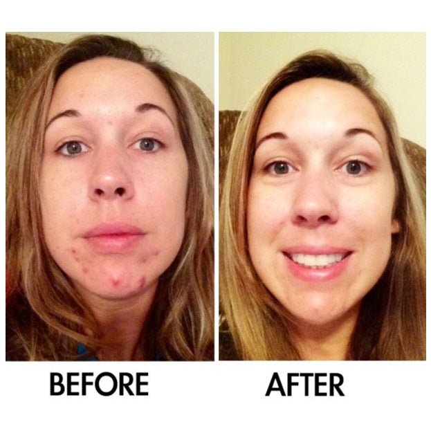 Derm #1 Skin Perfecting Serum with Prebiotics – Natural Acne & Rosacea Treatment