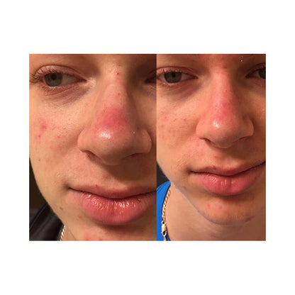 SkinSanity® Dual Action Acne Serum – Natural Salicylic Acid & Prebiotic Formula
