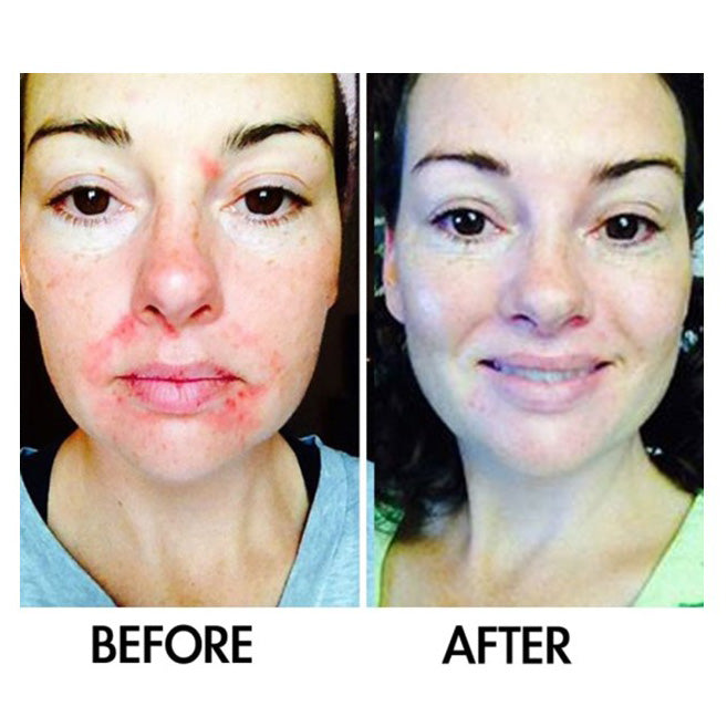 SkinSanity® Dual Action Acne Serum – Natural Salicylic Acid & Prebiotic Formula
