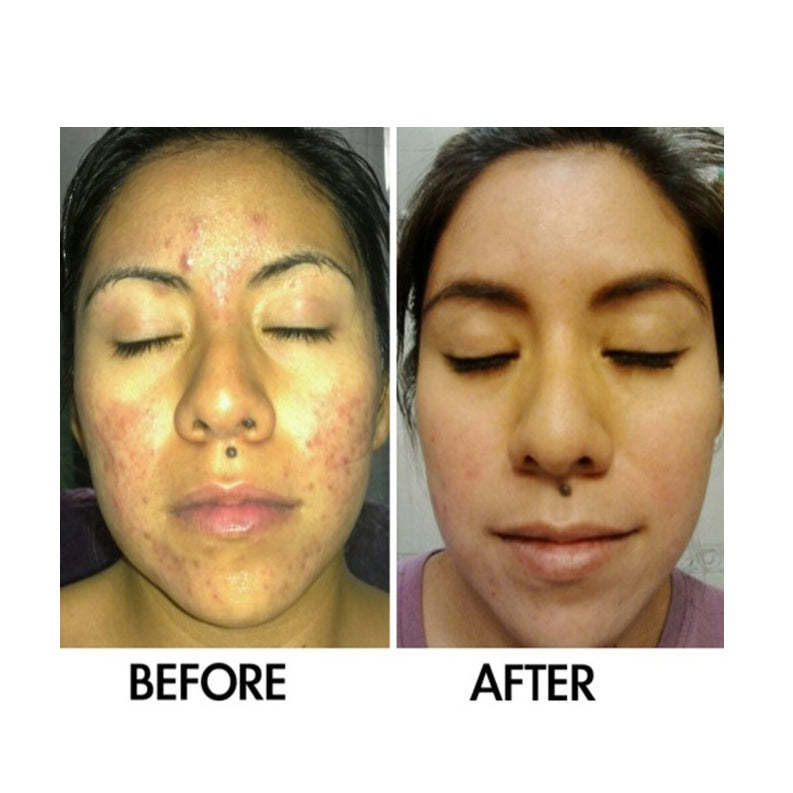 Derm #1 Skin Perfecting Serum with Prebiotics – Natural Acne & Rosacea Treatment