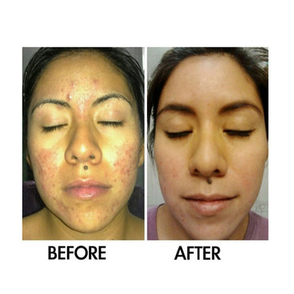 Derm #1 Skin Perfecting Serum with Prebiotics – Natural Acne & Rosacea Treatment
